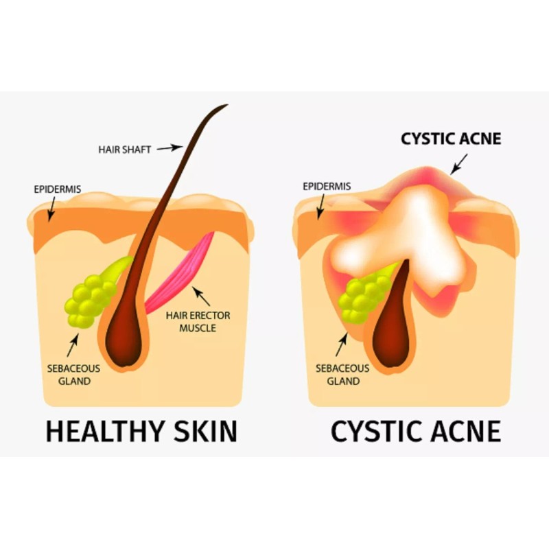 SUPPLEMENTS4ME ACNE CYSTIC REMOVAL - BACTERIA ACNE SOLUTION - Made