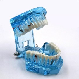 Tiferet Modelo Dental Patologías-tx Tipodonto Didáctico Azul