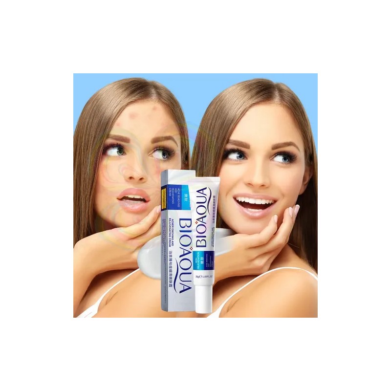 Pure Skin Anti Acné Retira Espinillas Grasa Crema 30g Full