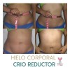 Hielos Reductivos Hieloterapia Kit 5 Hielos + Gel + Loción