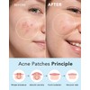 LitBear LitBear Acne Pimple Patches- Day and Night 6 Sizes