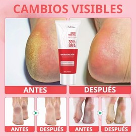 Paquete de 2 crema de urea al 30 por ciento para pies, crema de pies y manos de máxima fuerza con ácido hialurónico, aloe vera para hidrataciones prof
