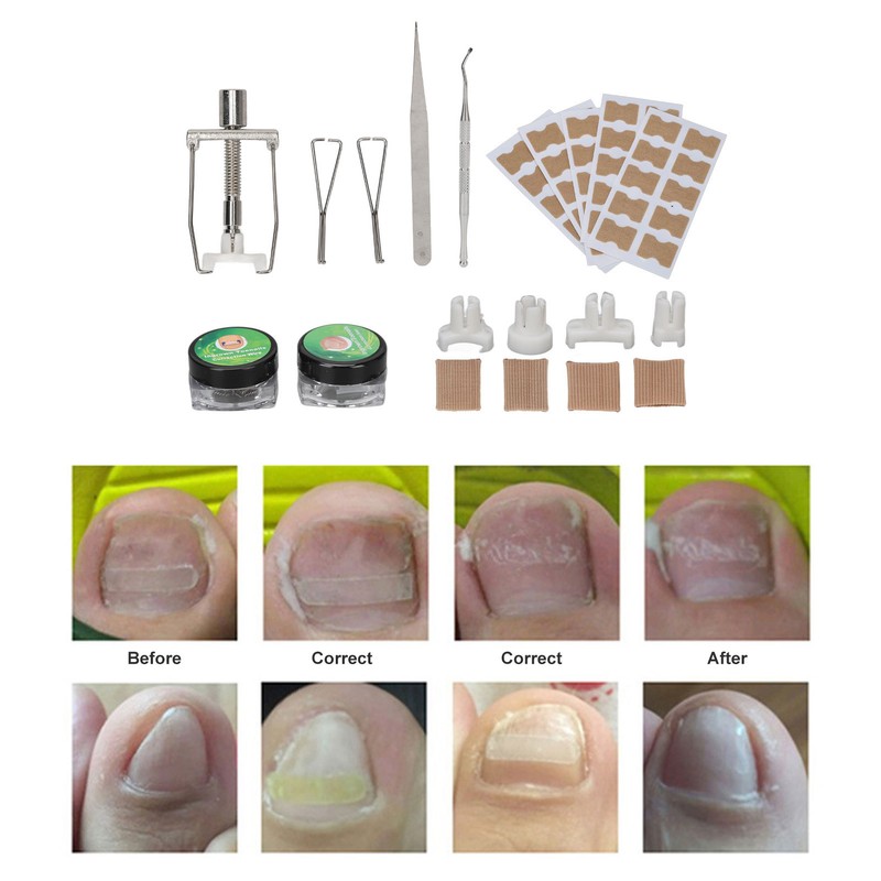 Ingrown Toenail Lifter Set Toenail Patch Sleeves Tweezers Stainless Steel