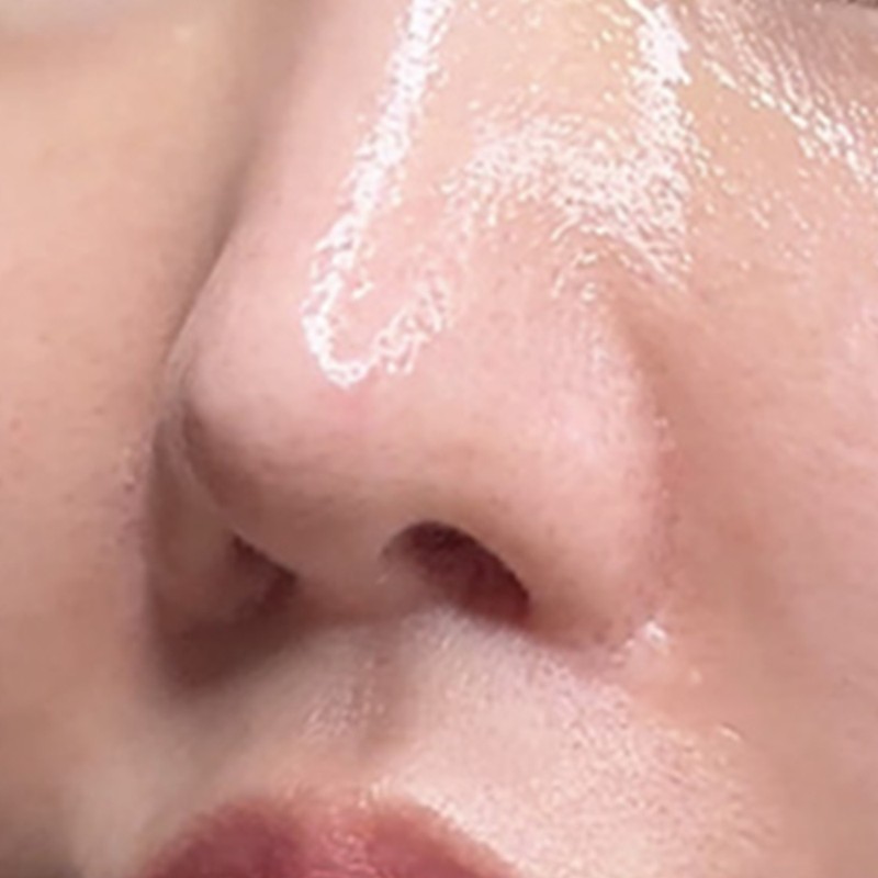 [Dermatology branch] Nose sebum softener ampoule dermatology peeling exfoliation /