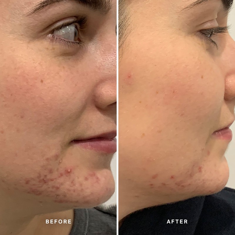 Alpha-H Clear Skin Tonic 30ml