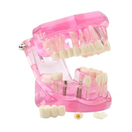 Dental Implant Teeth Model Disease Analysis Demonstration Standard Teeth Typodont Training Tooth Model with Removable Crown Bridge for Student Education(Pink）