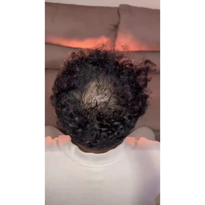 Volosy 5 Pack Fibras De Cabello Para Disimular Calvicie 28g