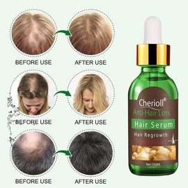 Anti-Hair Loss, Hair Growth Serum, Hair Loss and Hair Treatment, Hair Serum, 100 ml New Hair Growth Stimulates, Promotes Thicker, Fuller and Faster Growing Hair