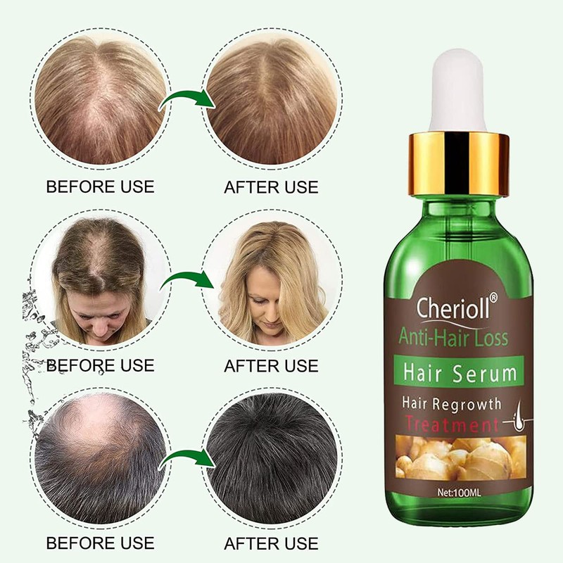 Anti-Hair Loss, Hair Growth Serum, Hair Loss and Hair Treatment,