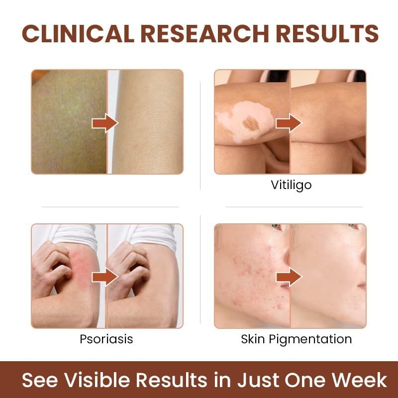 Vitiligo Cream, Natural Effective Vitiligo Treatment for Reduce White Spots