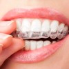 Veraly Protectores Bucales, Guardas Dentales De Gel Moldeables 2pz Color