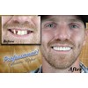 Professional Cosmetic Upper - New from Instant Smile! Hand Crafted
