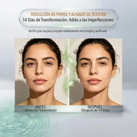 Suero Facial Exfoliante Acido Glicolico AHA BHA Serum Renovador Cutaneo Poros Dilatados Marcas De Acne Peeling Suave Tono Desigual Glow 30ml