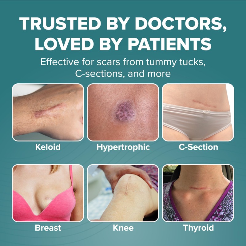 Epiderm Silicone Gel Scar Sheets - Premium-Grade Silicone Scar Sheets
