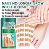 100PCS Ingrown Toenail Correction Patches, for Ingrown Toenail Treatment, Effective
