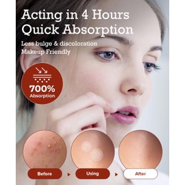 Zit Patches for Face - Invisible Spot Clear Pimple Patches - Fast Acting Thin Hydrocolloid Acne Dots Breakouts Treatment - Stickers Blemish Cover for Makeup Tea Tree, CICA, Madecassoside Waterproof