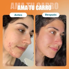 Sérum Peróxido Benzoilo 5% Eliminar La Cabeza Negra Del Acné