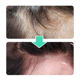 VT [Basic] VT PDRN Liddle Shot Scalp Ampoule 5 Bottles / 브이티 [기본] VT PDRN리들샷 두피앰플 5통