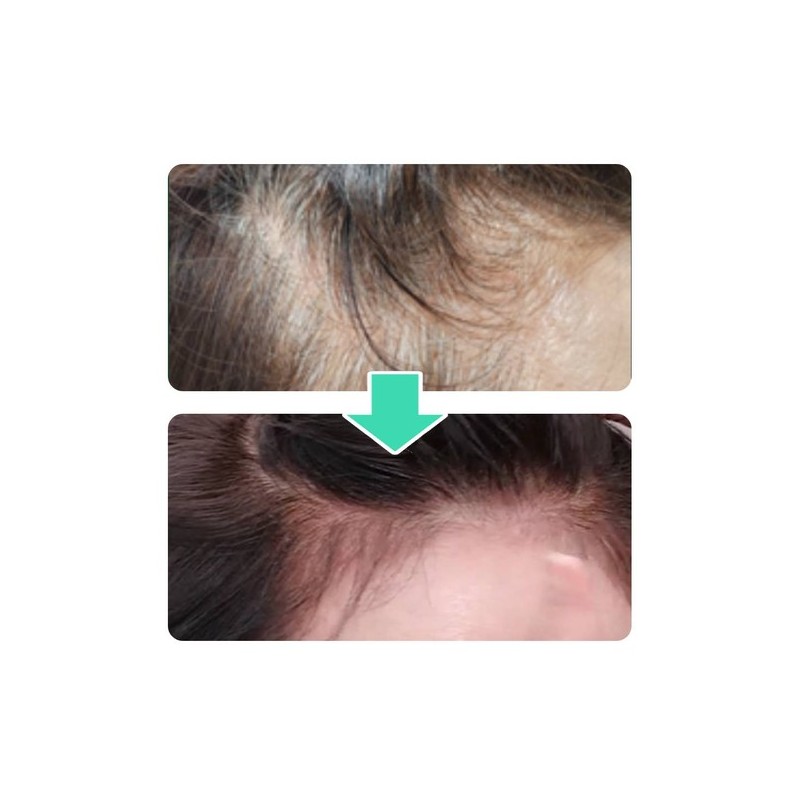 VT [Basic] VT PDRN Liddle Shot Scalp Ampoule 5 Bottles