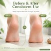 Tea Tree Foot Cream for Dry Rough Feet, Moisturizing Heel