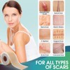 Professional Silicone Scar Sheets (1.6" x 150" Scar Roll-3.8M) -