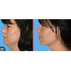 Crema Gel A, Hialuronico Reafirma Cuello Disminuye Papada 40