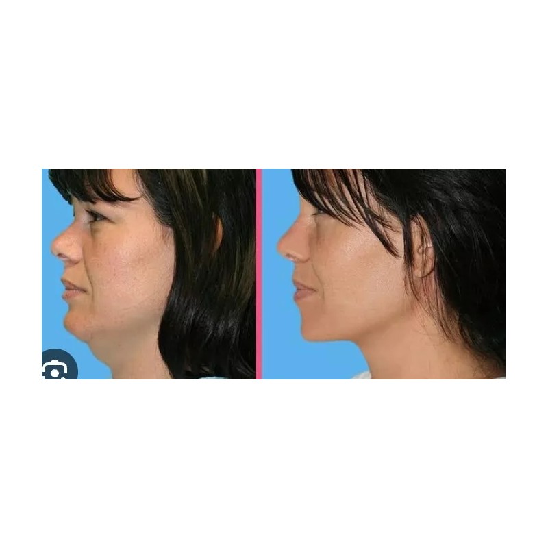 Crema Gel A, Hialuronico Reafirma Cuello Disminuye Papada 40