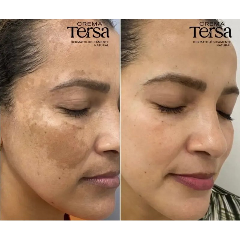 Crema Despigmentante Quita Manchas Acné Paño Vitíligo De 30g