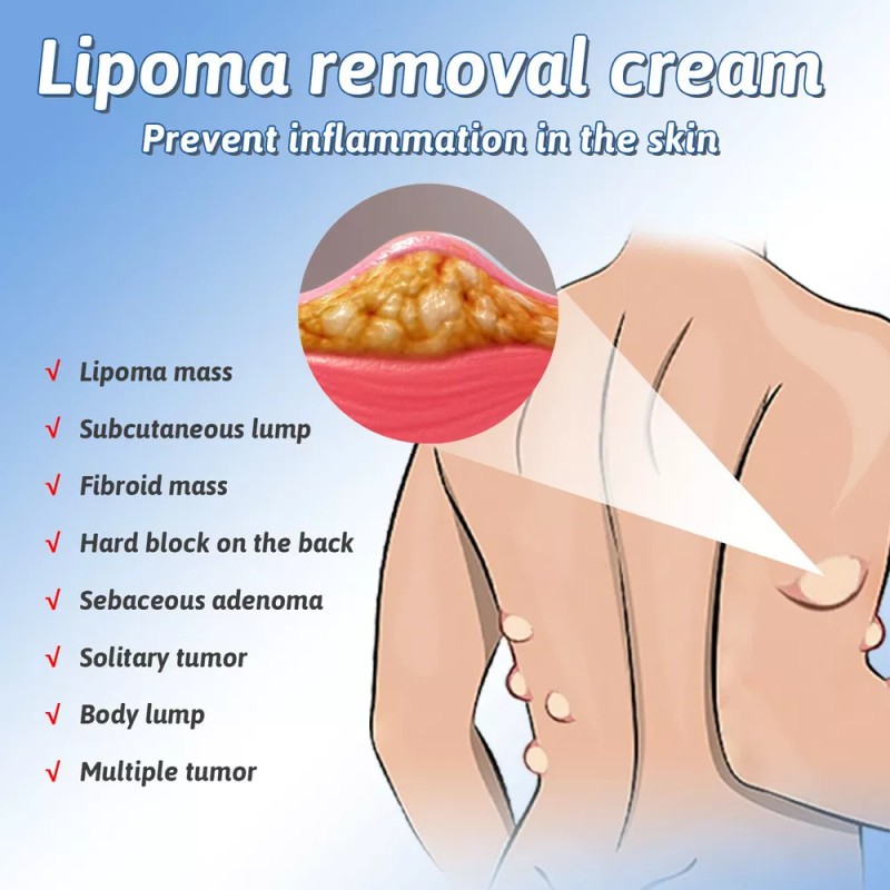 Generic 2× Crema De Eliminación De Lipomas Q Lipoma Cleaning