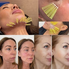 Auro Thread PDO Thread(Mono screw 30G 38MM) Lift/Face Body Lifting/Smooth Mono Type 38mm (50pieces)