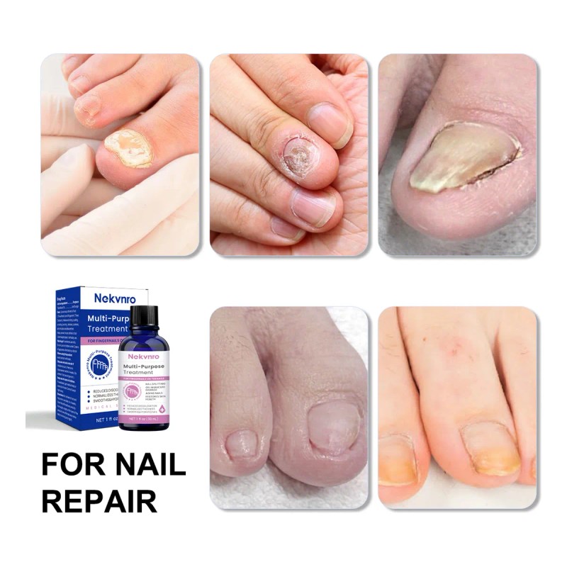 30ml Líquido Antibacteriano De Uñas Grises P/ Uñas Enfermas