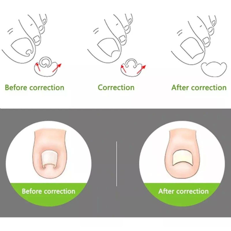 SJTR Corrector De Uñas Enterradas Pies Y Manos Encarnadas