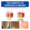Sistema De Verruga Elimina Plantar Y Comunes 30ml