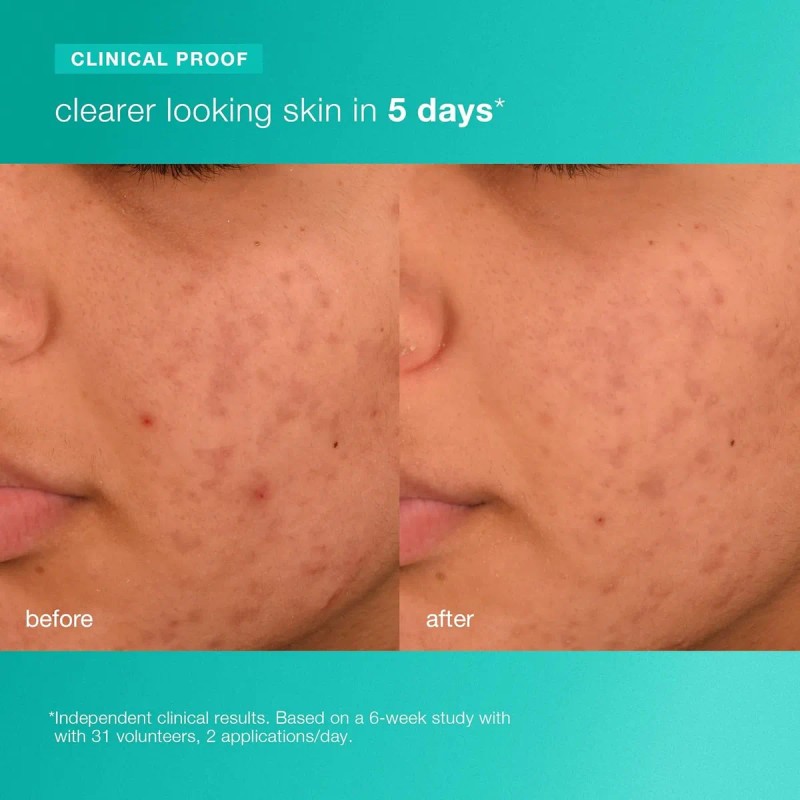 Dermalogica Hidratante Facial Biótico Para El Acné