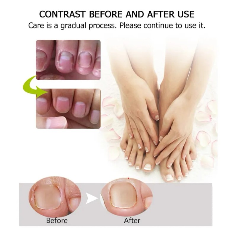 Gel Antihongo Tratamiento Reparador De Uñas Efero 2 Piezas