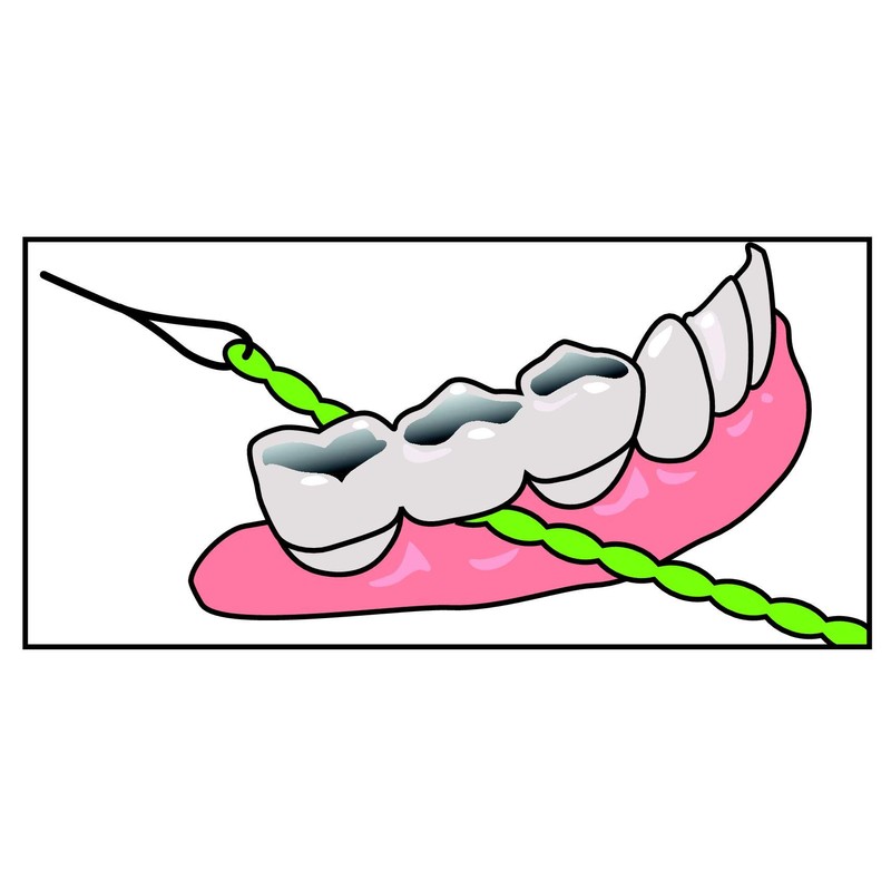 IDontix Brace X-Floss, Green