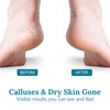 Gilden Tree Foot Callus Remover Kit - 40% Urea Cream