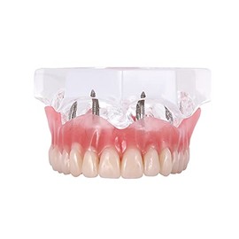 Modelo de implantes superiores dentales con 4 dientes superiores demostración de visión transparente para educación y estudio modelo herramienta M6001 C
