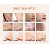 Skin Scrubber Vacuum Face Peeling 2 in 1 Dermabrasion Microdermabrasion