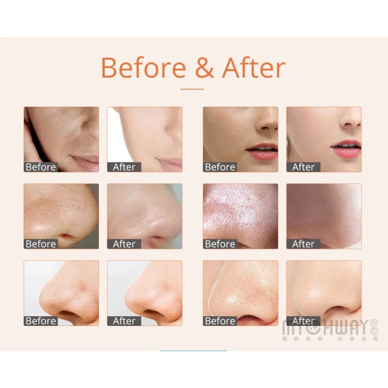 Skin Scrubber Vacuum Face Peeling 2 in 1 Dermabrasion Microdermabrasion