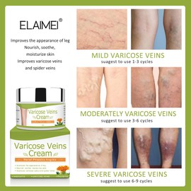 binoa IDUCEN Body Cream,Varicose Veins Cream, Varicose Veins Treatment for Legs,Varicose Veins Cream for Legs Eliminate Varicose Veins and Spider Veins, Relieve Pain of Legs
