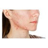 Treeactiv Crema Facial Acné Tratamiento Natural Promoción 3x