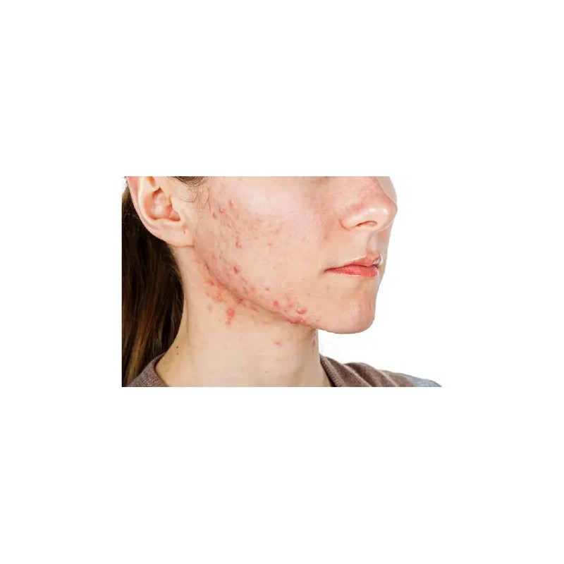Treeactiv Crema Facial Acné Tratamiento Natural Promoción 3x