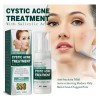 Jay Cystic Acne Tratamiento Para Eliminar Espinillas Barros Momento De