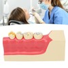 Right Lower Posterior Tooth Model 2X Magnification Detachable Resin Tooth