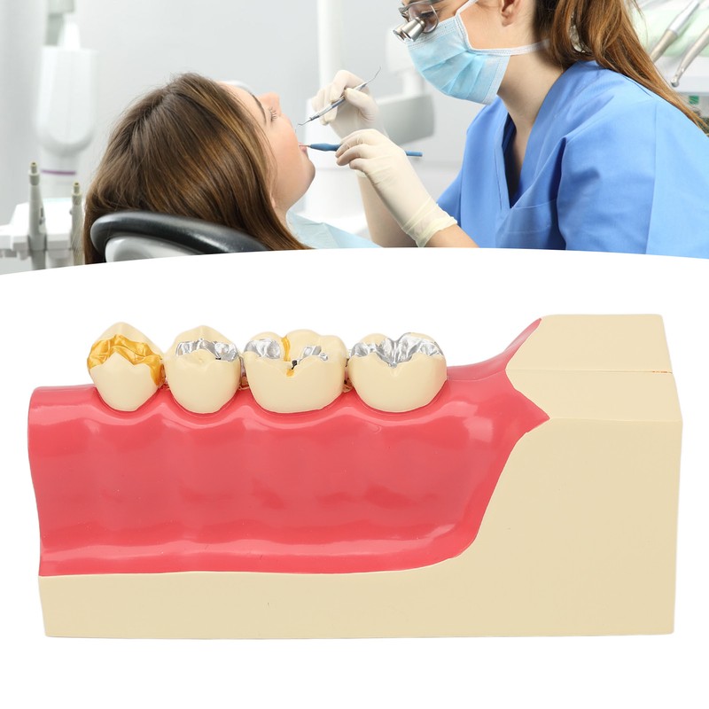 Right Lower Posterior Tooth Model 2X Magnification Detachable Resin Tooth