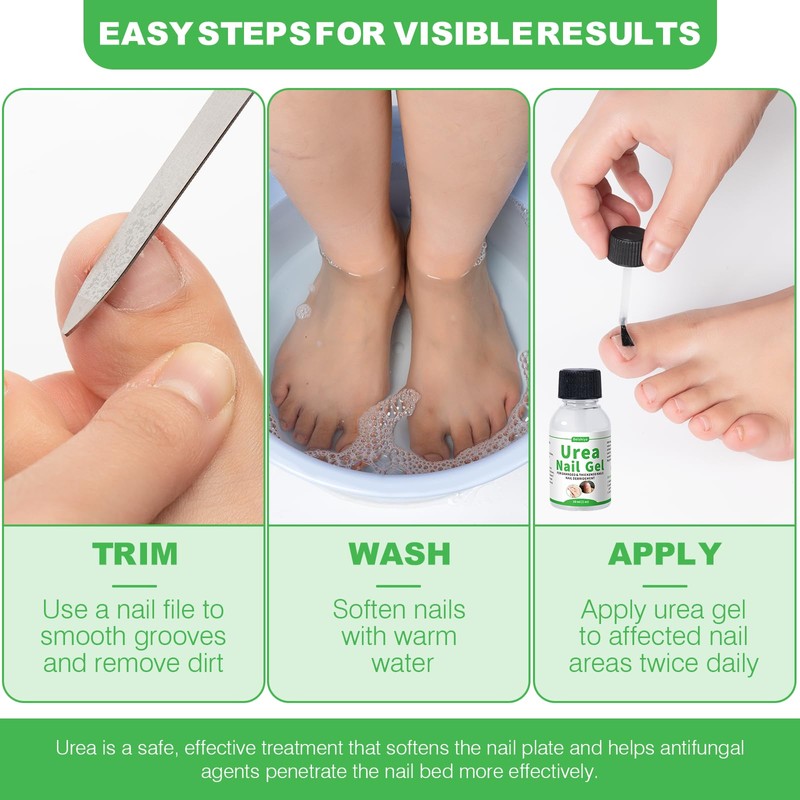 47% Urea Nail Gel – Medical-Grade Softening for Thick Toenails