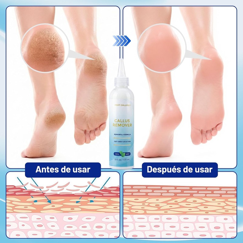 Foot Callus Remover Gel Extra Strength 6 oz – GIVOOBE