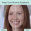 ProCure Rosacare Gel Para Reducción de Enrojecimiento