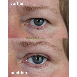 magic invisible Girl Size (S) – Eyelid Lifting Without OP [1X60PAAR]